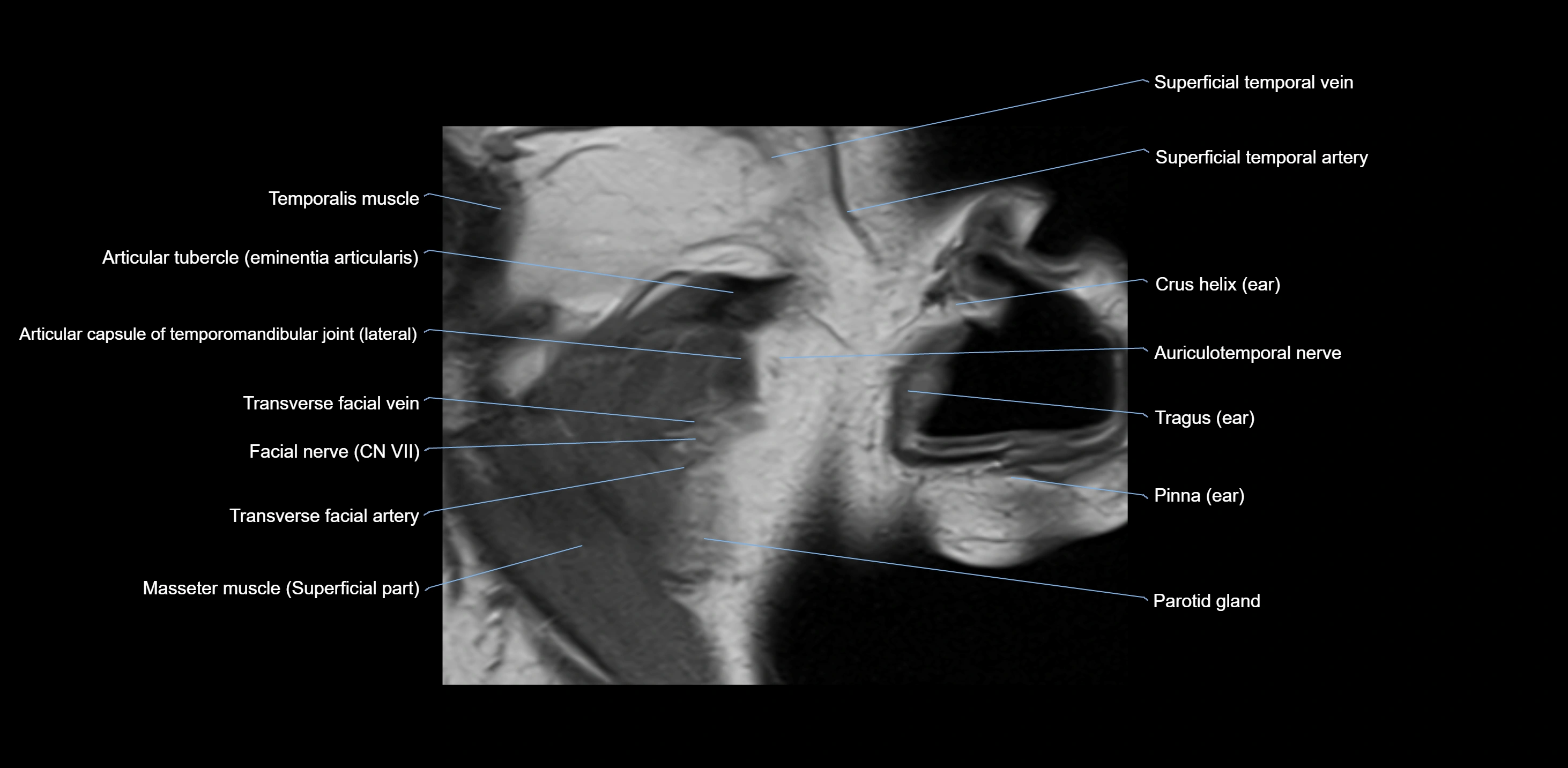 MRI TMJ sagittal open  mouth cross sectional 3T anatomy -img-00001-00001.webp